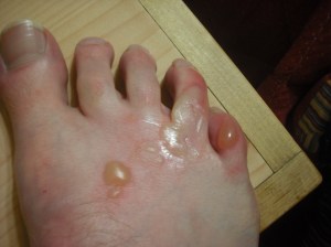 My foot twenty-four hours later after a day of driving AND my insistence that I put on my hiking boots long enough to walk a trail at the Dinosaur National Monument in Utah. Photo by Tim Graves